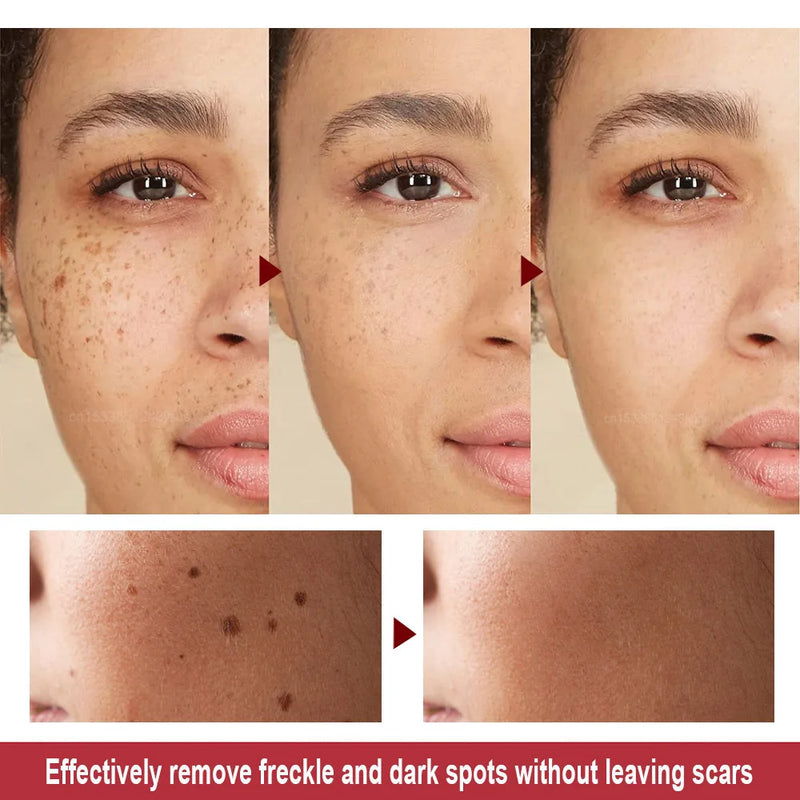 Caneta Laser 2 em 1 para Cuidados com a Pele