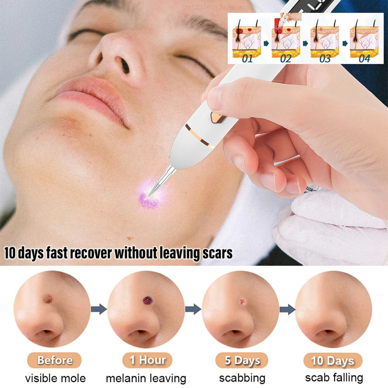 Caneta Laser 2 em 1 para Cuidados com a Pele